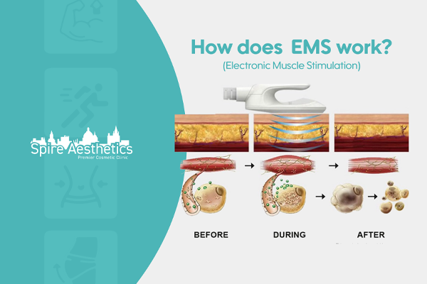 EMS treatment for post pregnancy weight loss treatment Warwickshire