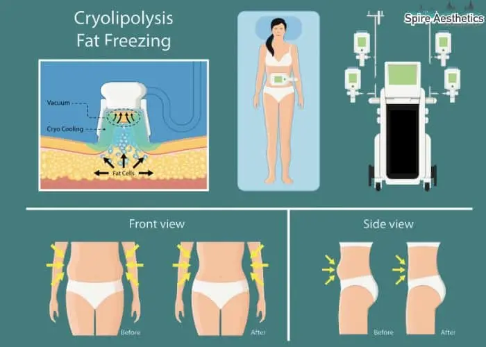 Fat freezing treatment Warwickshire benefits for competitions to remove stubborn fat deposits.