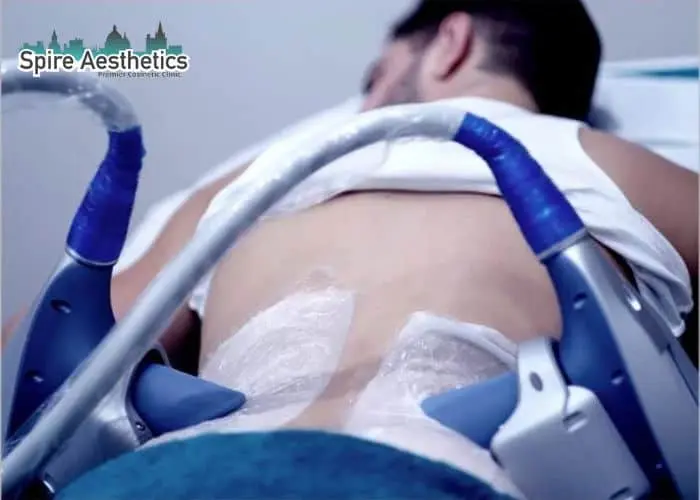 Man having fat freezing treatment done on love handles before a competitions Warwickshire to create a sculpted look.