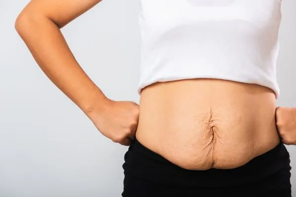 Image of a woman's stomach after weight loss with sagging skin following a gastric band Warwickshire
