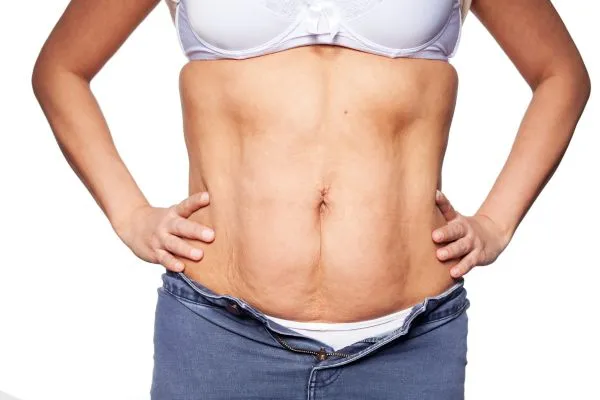 sagging skin on woman's stomach after weight loss injections Warwickshire