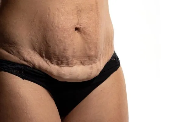 Image of womans stomach after weight loss injections Warwickshire showing saggy skin