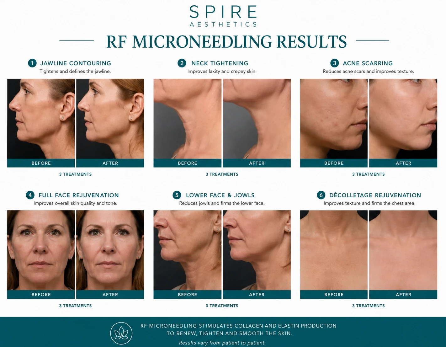 RF Microneedling Skin tightening Warwickshire results