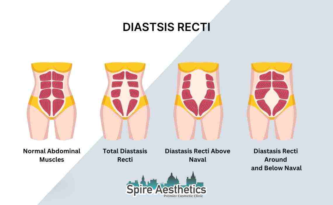 Is Non-Surgical Diastasis Recti Treatment Right for You? Common Concerns Answered Warwickshire